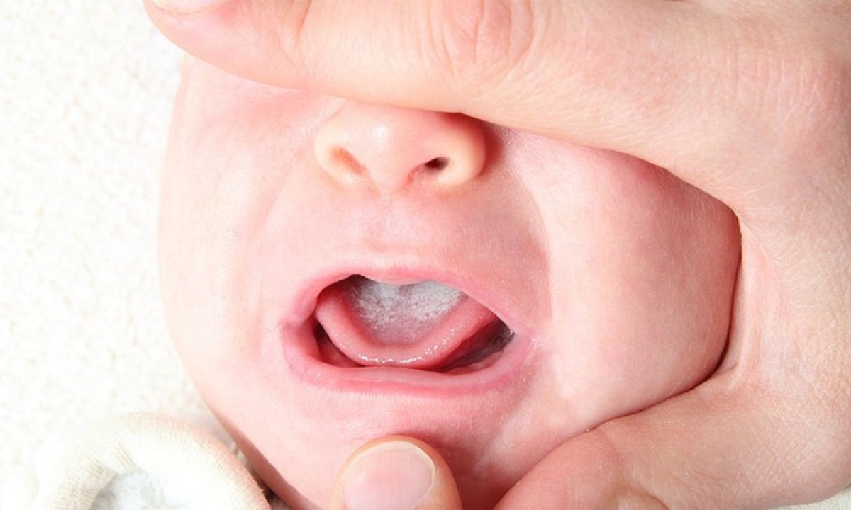 Bệnh nấm lưỡi với biểu hiện là những mảng trắng trên lưỡi của bé